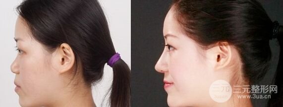 假体隆鼻术后可以戴眼镜吗，有影响吗