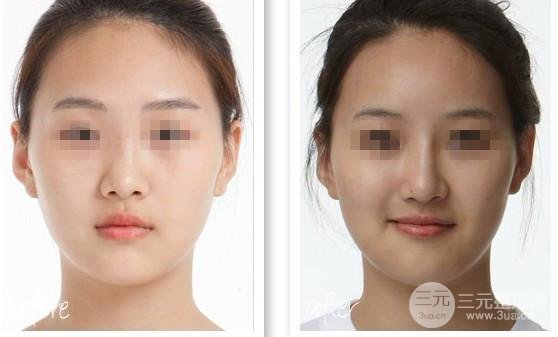 假体隆鼻术后需要拆线吗，拆线疼吗