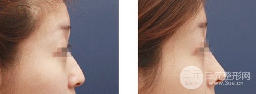 假体隆鼻术后可以运动吗，需要注意什么