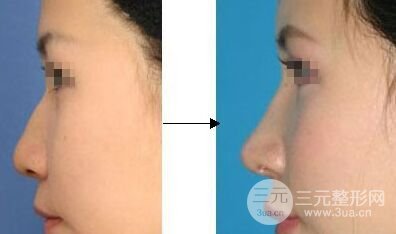 假体隆鼻整形容易变形、移位吗