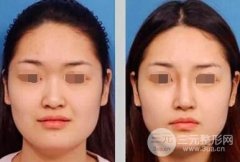 假体隆鼻后看起来自然吗,会不会很假 假体隆鼻后看起来自然吗,会不会很假