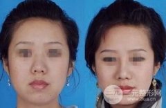 有鼻炎的人可以做假体隆鼻手术吗 有鼻炎的人可以做假体隆鼻手术吗