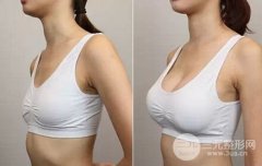 隆胸的假体材料一般可以保持多少年