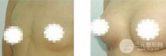 假体隆胸术后可以哺乳吗，对身体健康有影响吗