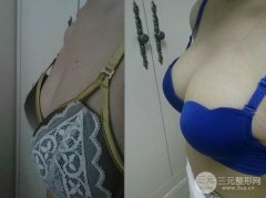 假体隆胸之后如何护理才能恢复较快自然