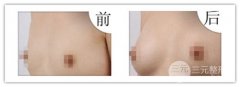 假体隆胸后可以运动吗，可以锻炼吗