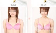 做自体脂肪隆胸疼不疼