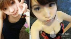 自体脂肪丰胸手术会出现副作用吗
