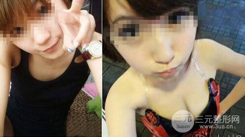 自体脂肪丰胸手术会出现副作用吗