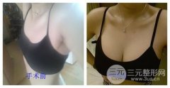 自体脂肪隆胸术后多久才能基本恢复