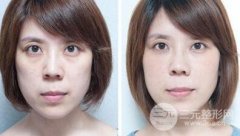 激光去眼袋术后怎样护理 激光去眼袋术后怎样护理