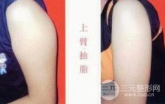 手臂吸脂整形贵吗
