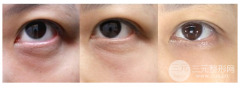 黑眼圈怎样快速祛除?激光去黑眼圈果怎么样? 黑眼圈怎样快速祛除?激光去黑眼圈果怎么样?