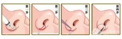 鼻孔大怎么缩小？鼻孔缩小手术是怎样的？