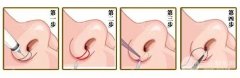 鼻孔大怎么缩小?鼻孔缩小手术是怎样的? 鼻孔大怎么缩小?鼻孔缩小手术是怎样的?