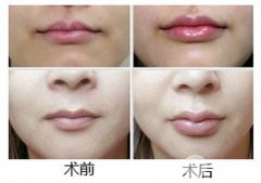 玻尿酸丰唇手术痛不痛?果怎么样? 玻尿酸丰唇手术痛不痛?果怎么样?