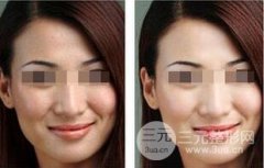 全身激光美白需要多少钱？