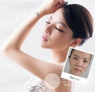 丰太阳穴手术前需要准备什么？