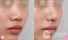 隆鼻失败取出假体需要多少钱? 隆鼻失败取出假体需要多少钱?