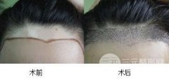 头发种植美人尖的过程详解 头发种植美人尖的过程详解