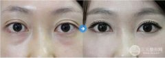 眼部整形激光去眼袋的禁忌人群有哪些? 眼部整形激光去眼袋的禁忌人群有哪些?