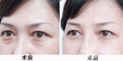 眼部整形激光去眼袋会有后遗症吗?术后如何护理? 眼部整形激光去眼袋会有后遗症吗?术后如何护理?