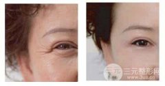 面部整形如何去除眼角细纹?术后护理?