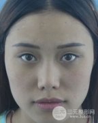 我眼部做双眼皮整形失败可以手术修复吗？北京要多少钱？