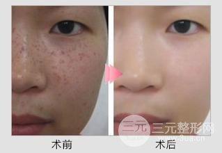 激光去黄褐斑需要做几次才能去除干净