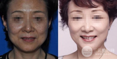 激光去老年斑成好吗，要如何护理