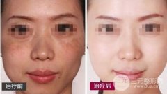 激光祛斑会有副作用吗，缓解后要如何护理