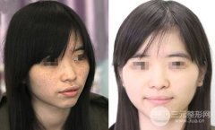 白瓷娃娃去晒斑的降低风险吗，有副作用吗
