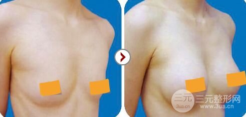 假体隆胸整形术后多久恢复、如何护理比较好
