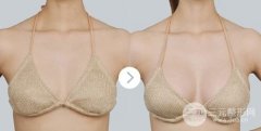 假体隆胸对哺乳有影响吗，会不会危害身体健康