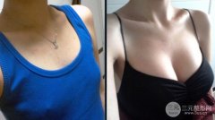 假体隆胸手术疼吗、过程会不会很痛苦