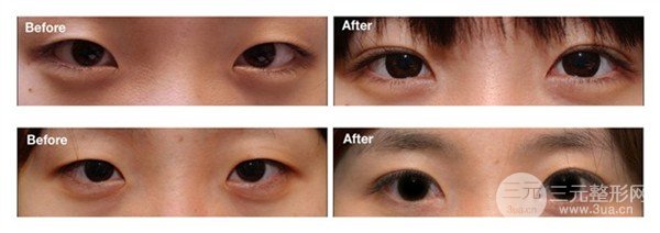近视眼可以做双眼皮手术吗，会有影响吗