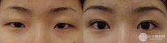 做双眼皮手术降低风险吗，有后遗症较轻（不代表不会出现后遗症）