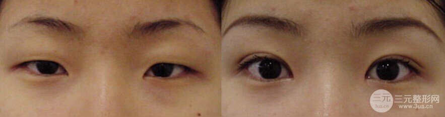 做双眼皮手术降低风险吗，有后遗症较轻（不代表不会出现后遗症）