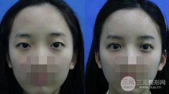 做完双眼皮术后果不明X怎么办，可以重做吗