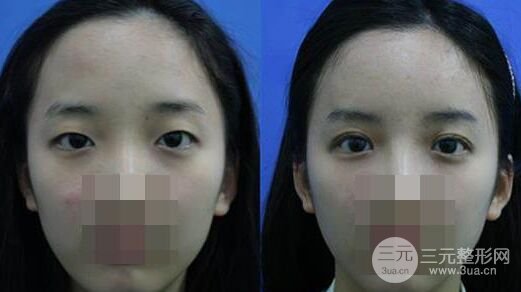做完双眼皮术后果不明X怎么办，可以重做吗
