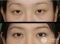 如何确定双眼皮宽度，怎么做才适合自己