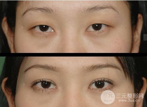 如何确定双眼皮宽度,怎么做才适合自己