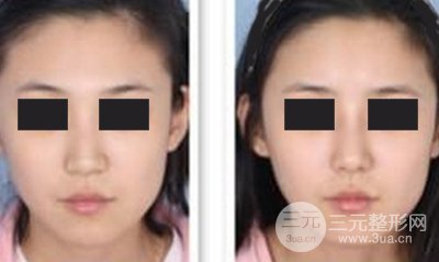如何选择适合的隆鼻整形方法，哪种方法才能让你得到美丽鼻型