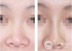 假体隆鼻整形术后可以戴眼镜吗,多久能恢复好 假体隆鼻整形术后可以戴眼镜吗,多久能恢复好