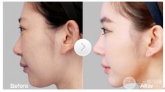 综合鼻整形手术可以解决哪些鼻部问题