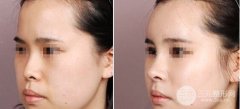 自体软骨隆鼻术后几天消肿,多久能基本恢复 自体软骨隆鼻术后几天消肿,多久能基本恢复