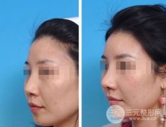 自体软骨隆鼻真的那么好吗,有哪些好处 自体软骨隆鼻真的那么好吗,有哪些好处