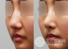 自体耳软骨垫鼻尖一般可以维持多长的时间 自体耳软骨垫鼻尖一般可以维持多长的时间