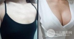 自体脂肪移植需要知道哪些事情