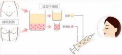 自体脂肪填充泪沟后需要注意些什么